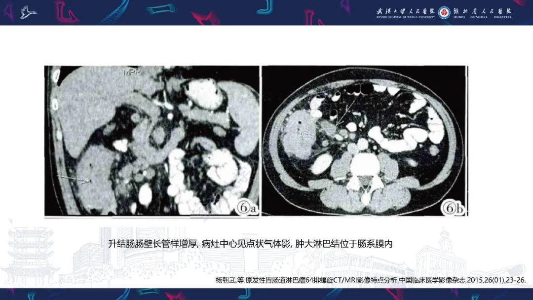 影像PPT - 【PPT】原发性大肠淋巴瘤影像诊断-16