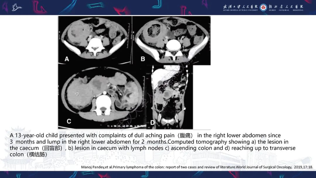 影像PPT - 【PPT】原发性大肠淋巴瘤影像诊断-20