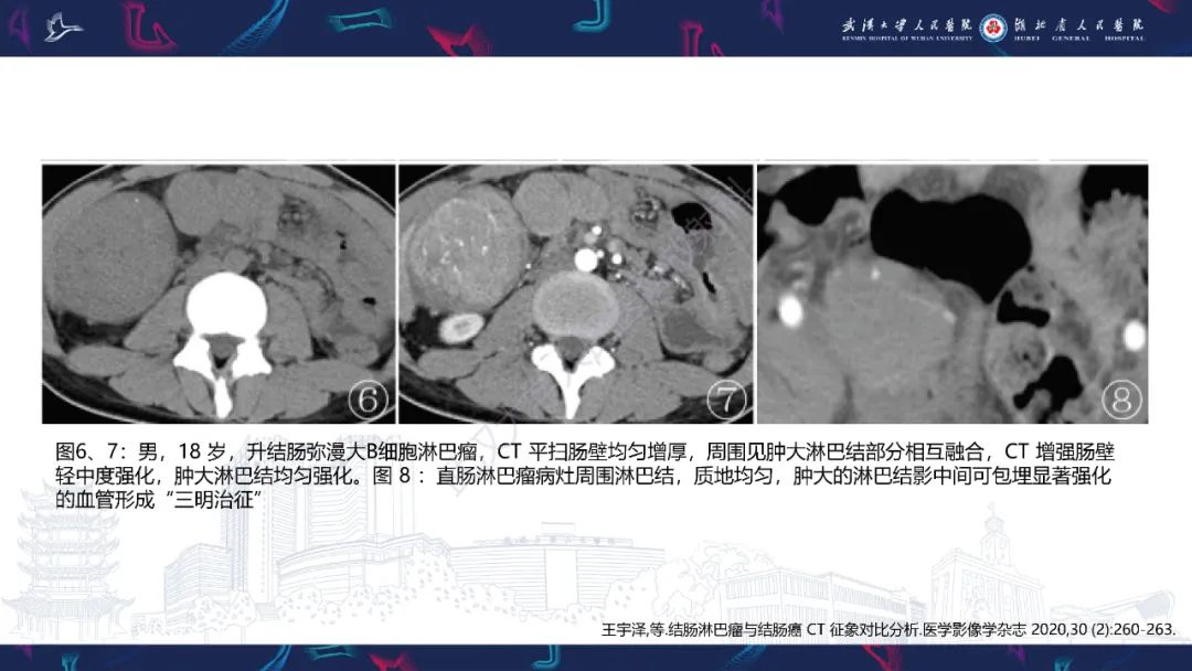 影像PPT - 【PPT】原发性大肠淋巴瘤影像诊断-17