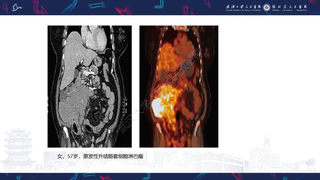 影像PPT - 【PPT】原发性大肠淋巴瘤影像诊断-25