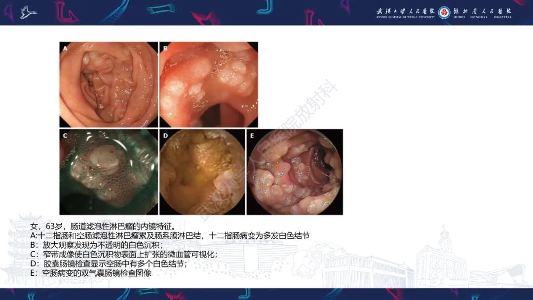 影像PPT - 【PPT】原发性大肠淋巴瘤影像诊断-27