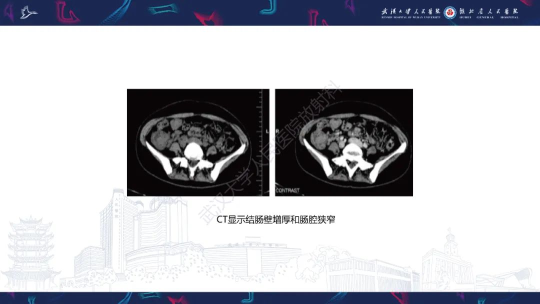 影像PPT - 【PPT】原发性大肠淋巴瘤影像诊断-28