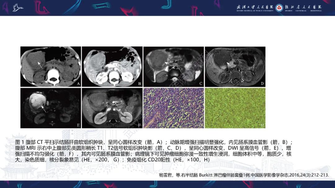 影像PPT - 【PPT】原发性大肠淋巴瘤影像诊断-30