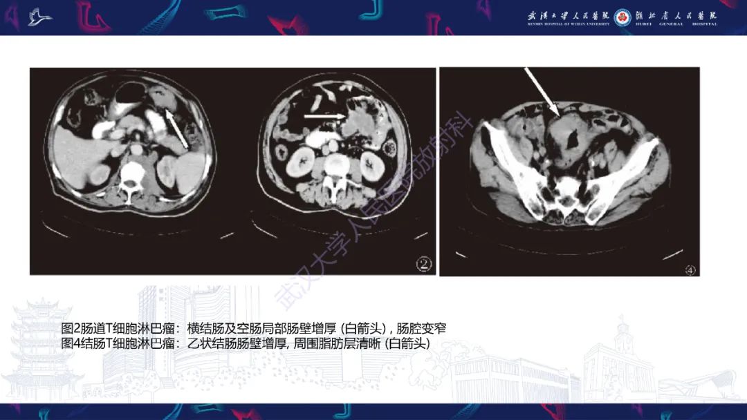 影像PPT - 【PPT】原发性大肠淋巴瘤影像诊断-32