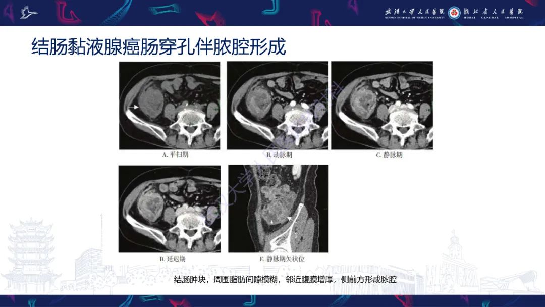 影像PPT - 【PPT】原发性大肠淋巴瘤影像诊断-34