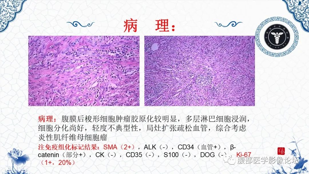 影像PPT - 【病例】腹膜后炎性肌纤维母细胞瘤1例CT及MR诊断及鉴别-18