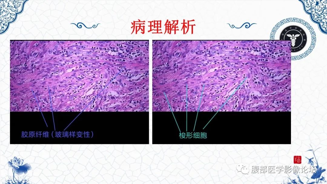 影像PPT - 【病例】腹膜后炎性肌纤维母细胞瘤1例CT及MR诊断及鉴别-20