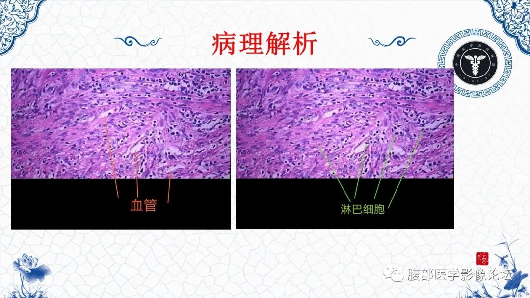 影像PPT - 【病例】腹膜后炎性肌纤维母细胞瘤1例CT及MR诊断及鉴别-19