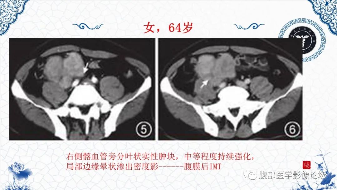 影像PPT - 【病例】腹膜后炎性肌纤维母细胞瘤1例CT及MR诊断及鉴别-28