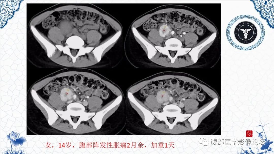 影像PPT - 【病例】腹膜后炎性肌纤维母细胞瘤1例CT及MR诊断及鉴别-29