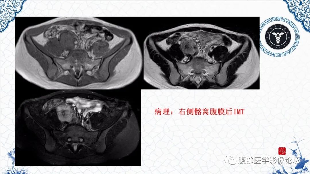 影像PPT - 【病例】腹膜后炎性肌纤维母细胞瘤1例CT及MR诊断及鉴别-30