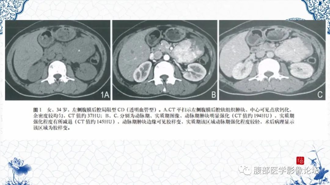 影像PPT - 【病例】腹膜后炎性肌纤维母细胞瘤1例CT及MR诊断及鉴别-32