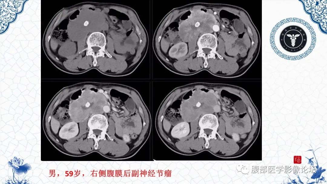 影像PPT - 【病例】腹膜后炎性肌纤维母细胞瘤1例CT及MR诊断及鉴别-34