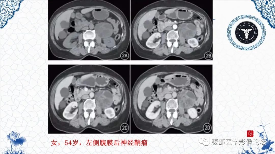 影像PPT - 【病例】腹膜后炎性肌纤维母细胞瘤1例CT及MR诊断及鉴别-36