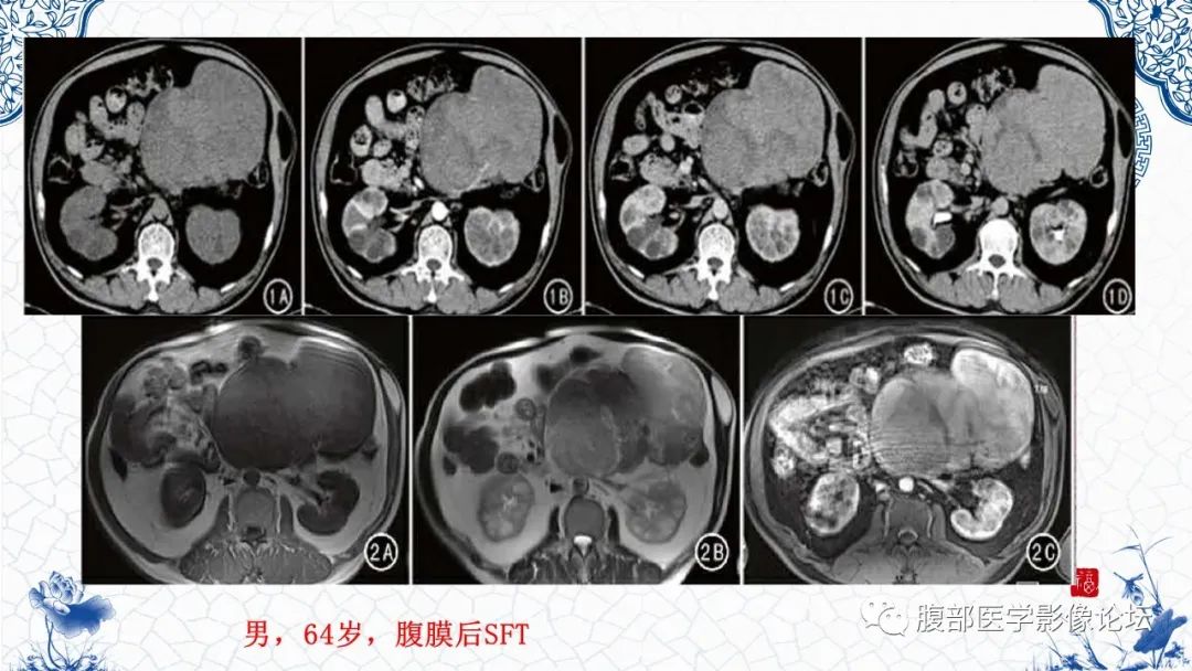 影像PPT - 【病例】腹膜后炎性肌纤维母细胞瘤1例CT及MR诊断及鉴别-38