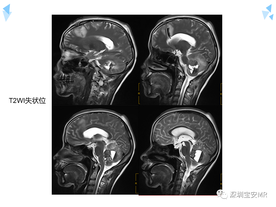 影像PPT - 【病例】成人型髓母细胞瘤2例CT及MR影像-5