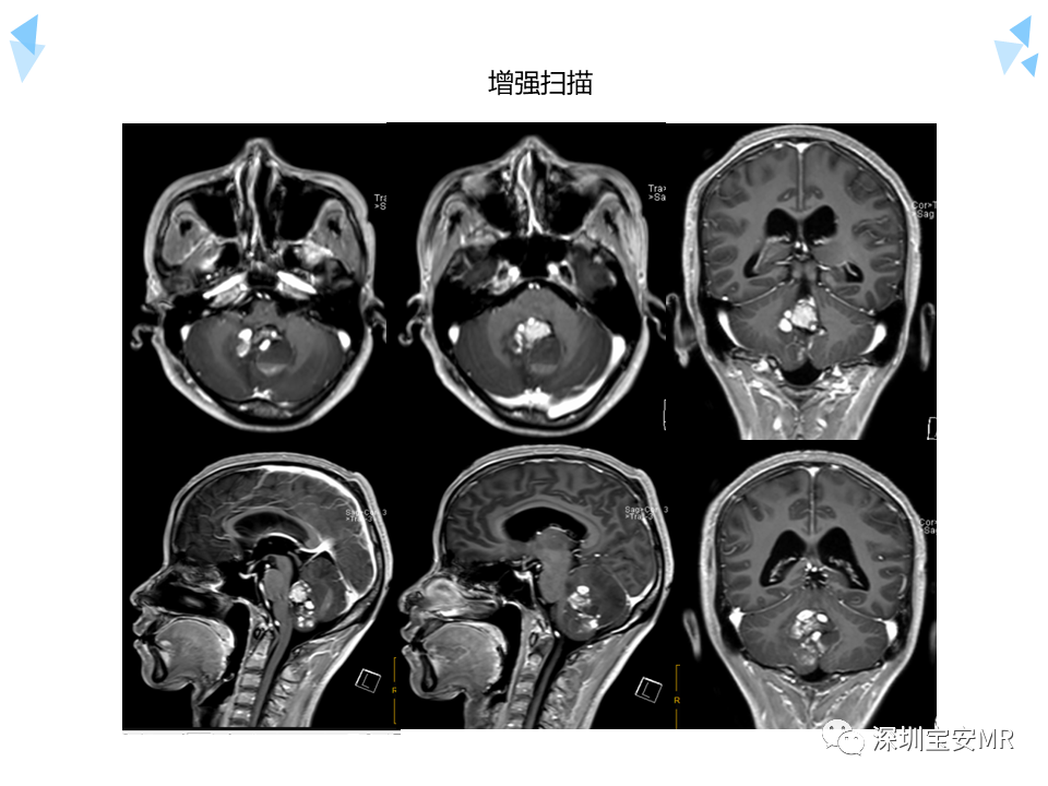 影像PPT - 【病例】成人型髓母细胞瘤2例CT及MR影像-7
