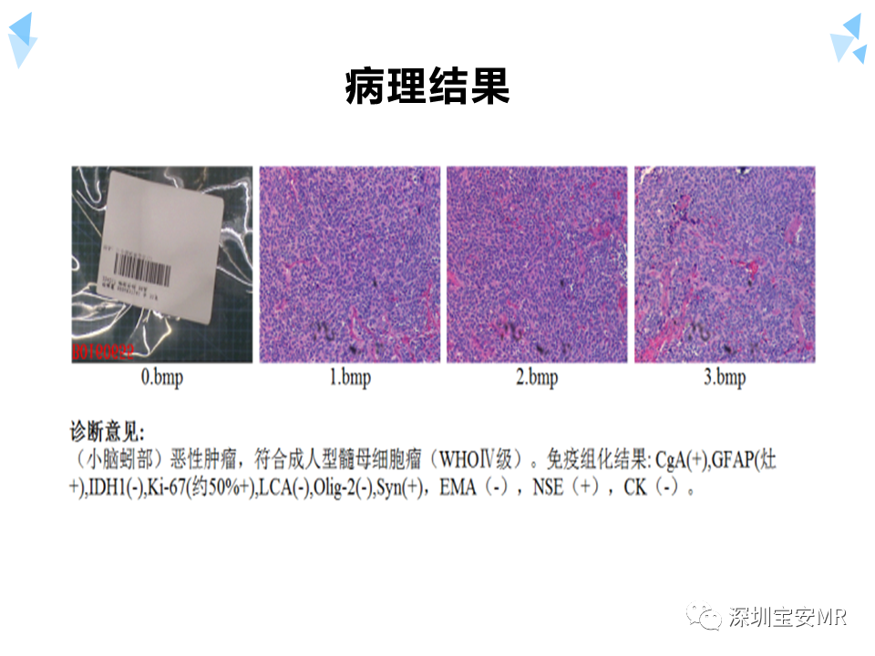 影像PPT - 【病例】成人型髓母细胞瘤2例CT及MR影像-10