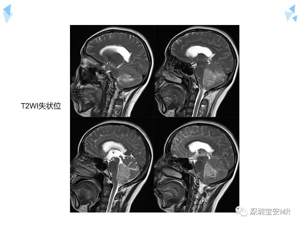 影像PPT - 【病例】成人型髓母细胞瘤2例CT及MR影像-15