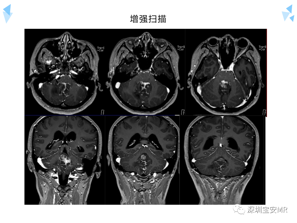 影像PPT - 【病例】成人型髓母细胞瘤2例CT及MR影像-16