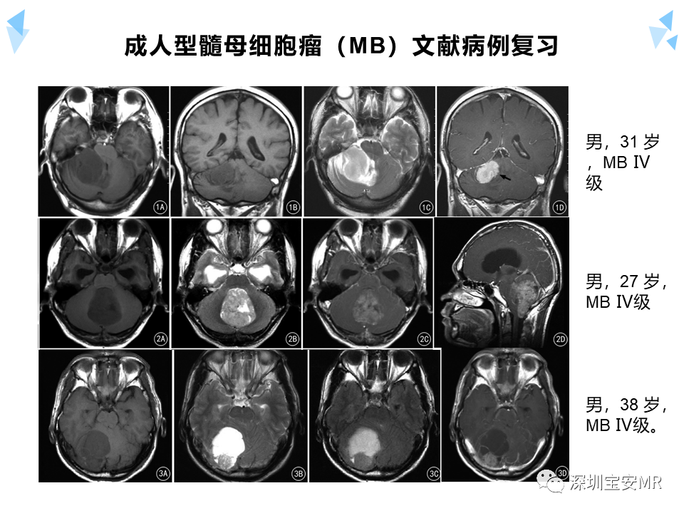 影像PPT - 【病例】成人型髓母细胞瘤2例CT及MR影像-22