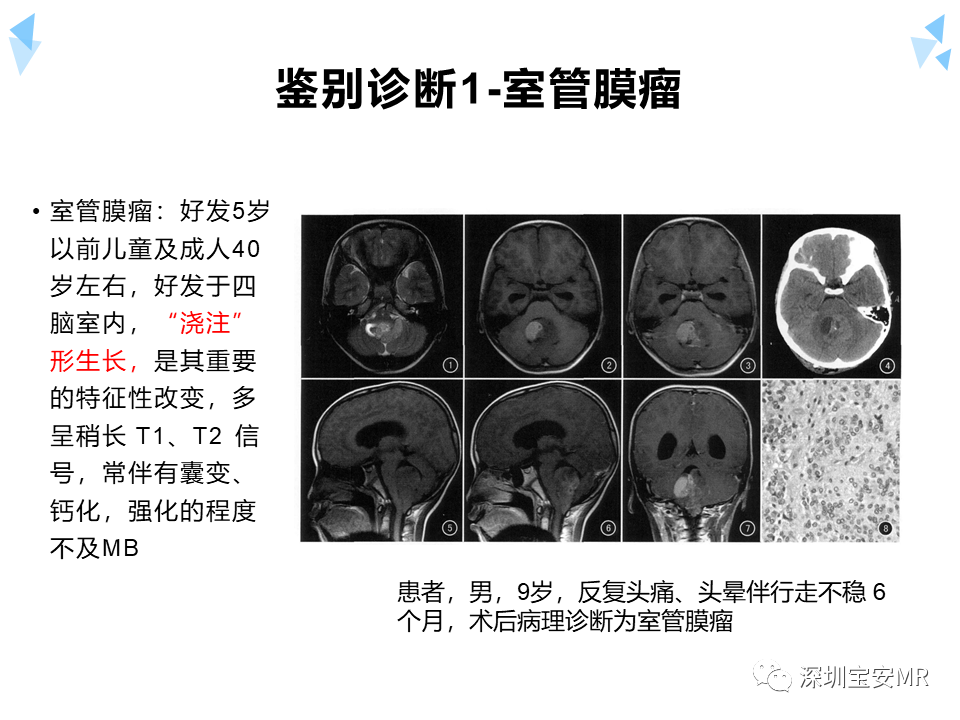 影像PPT - 【病例】成人型髓母细胞瘤2例CT及MR影像-23