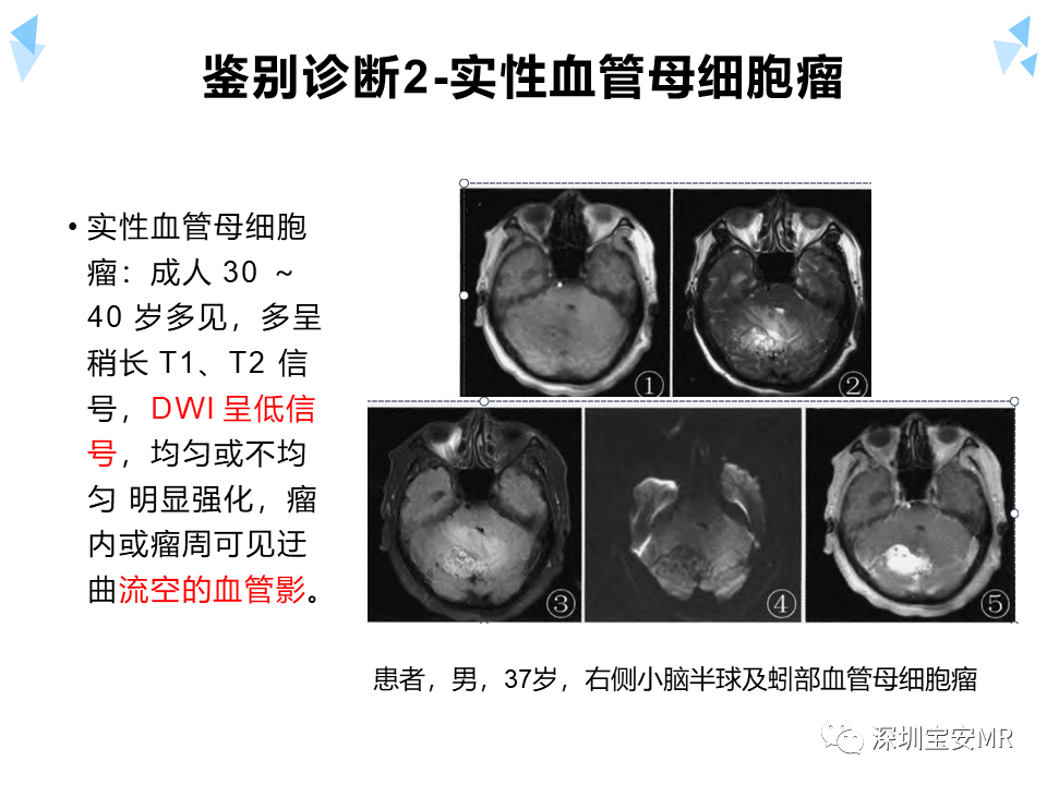 影像PPT - 【病例】成人型髓母细胞瘤2例CT及MR影像-24