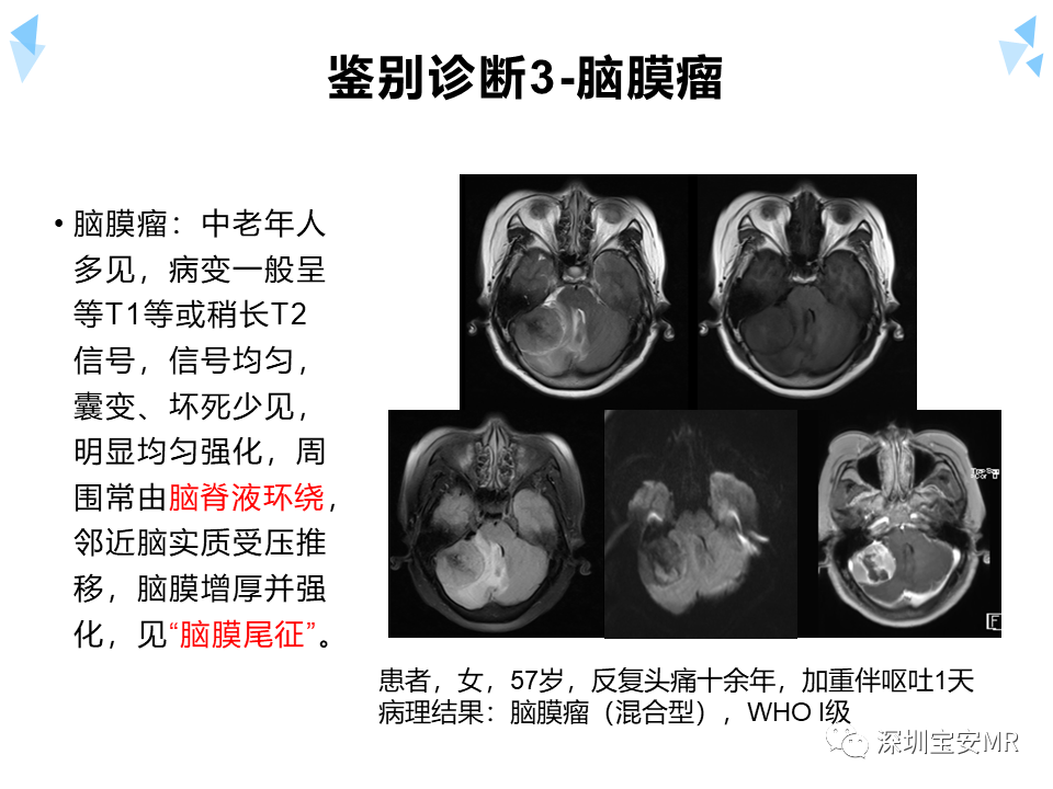 影像PPT - 【病例】成人型髓母细胞瘤2例CT及MR影像-25