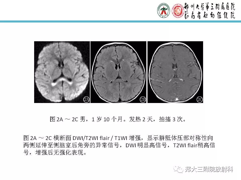 影像PPT - 【PPT】可逆性胼胝体压部病变综合征-9