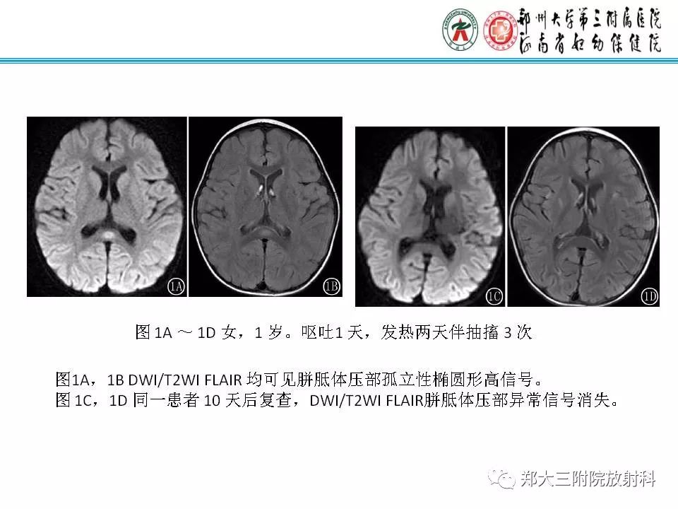 影像PPT - 【PPT】可逆性胼胝体压部病变综合征-8