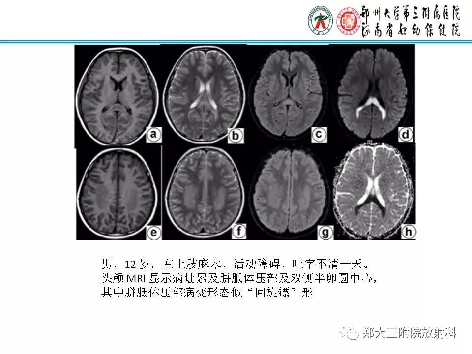 影像PPT - 【PPT】可逆性胼胝体压部病变综合征-10