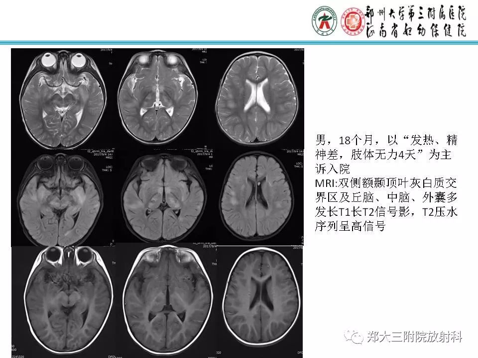 影像PPT - 【PPT】可逆性胼胝体压部病变综合征-13