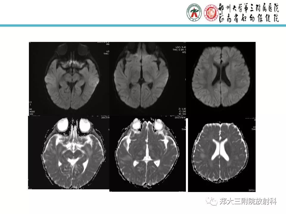 影像PPT - 【PPT】可逆性胼胝体压部病变综合征-14