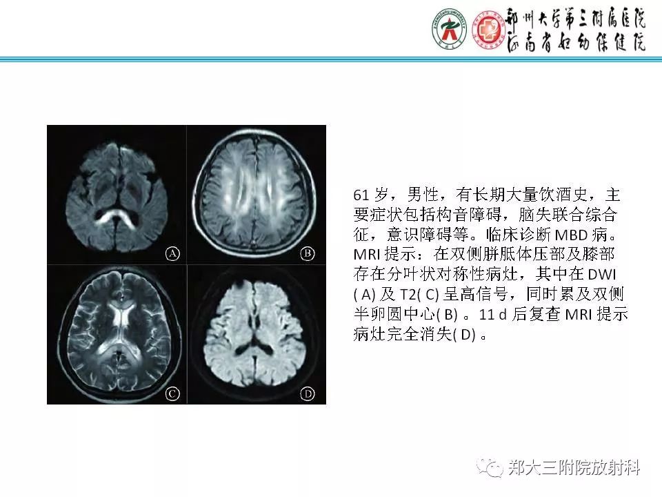 影像PPT - 【PPT】可逆性胼胝体压部病变综合征-16