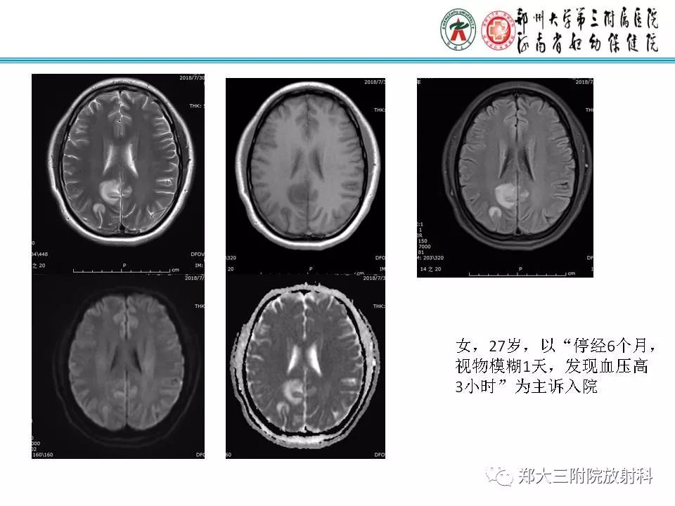 影像PPT - 【PPT】可逆性胼胝体压部病变综合征-18