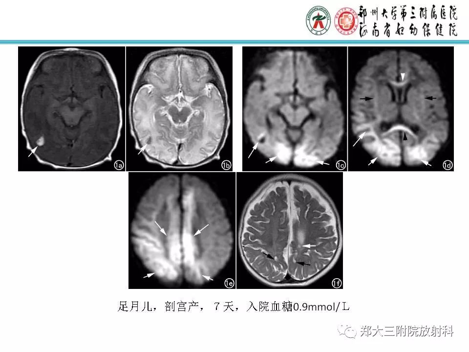 影像PPT - 【PPT】可逆性胼胝体压部病变综合征-22