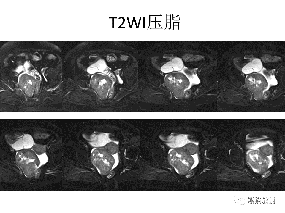 影像PPT - 【病例】卵巢卵泡膜纤维瘤2例MR影像-4