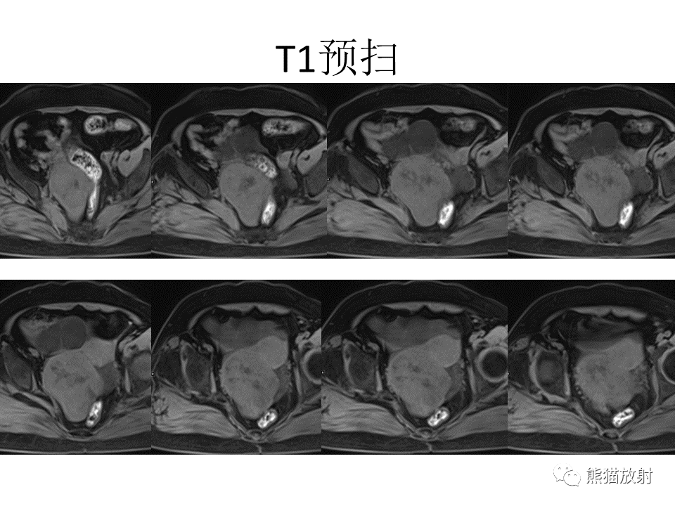 影像PPT - 【病例】卵巢卵泡膜纤维瘤2例MR影像-5