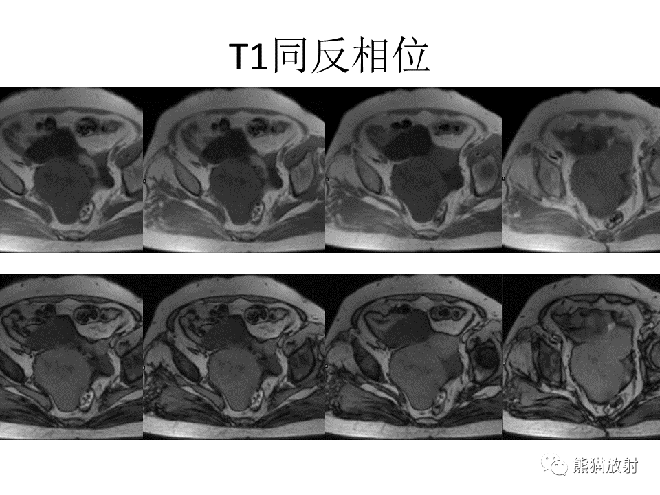 影像PPT - 【病例】卵巢卵泡膜纤维瘤2例MR影像-6
