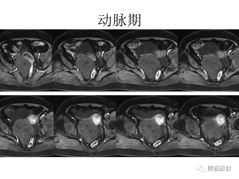影像PPT - 【病例】卵巢卵泡膜纤维瘤2例MR影像-8