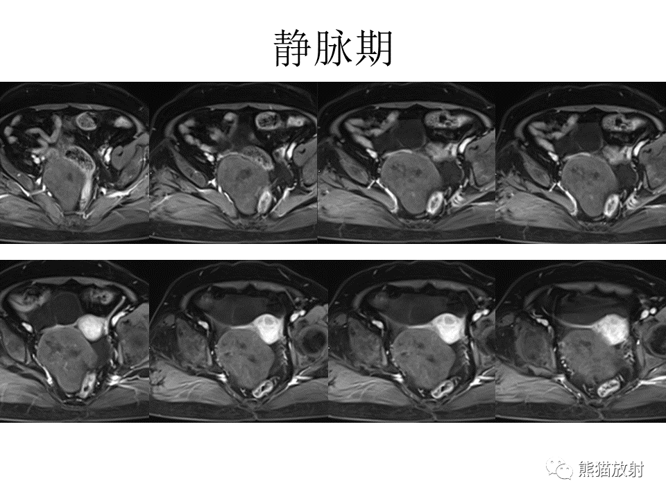 影像PPT - 【病例】卵巢卵泡膜纤维瘤2例MR影像-9
