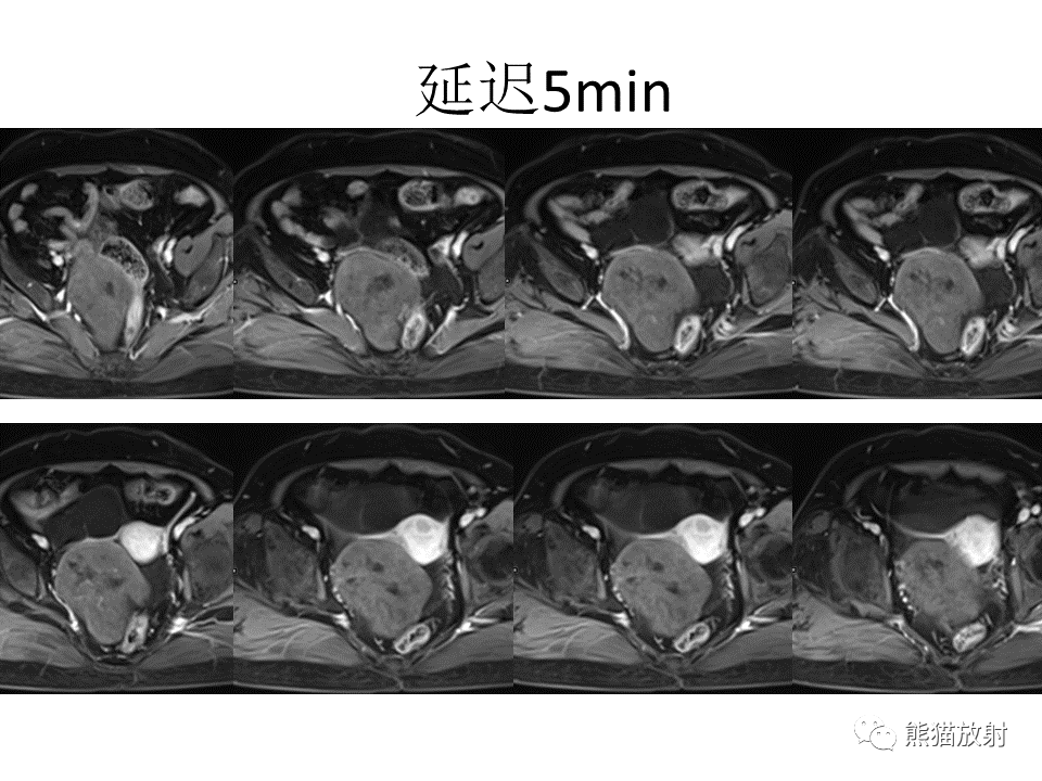 影像PPT - 【病例】卵巢卵泡膜纤维瘤2例MR影像-10