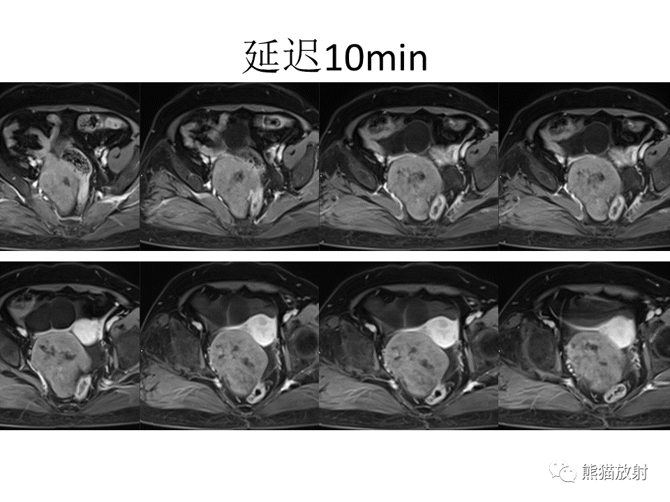影像PPT - 【病例】卵巢卵泡膜纤维瘤2例MR影像-11