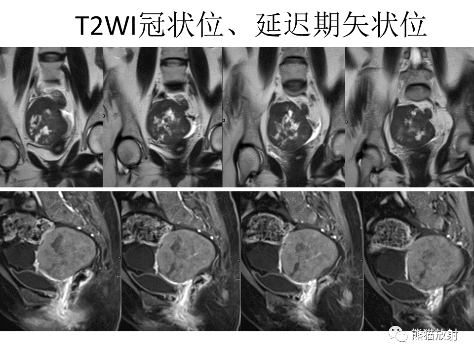 影像PPT - 【病例】卵巢卵泡膜纤维瘤2例MR影像-12