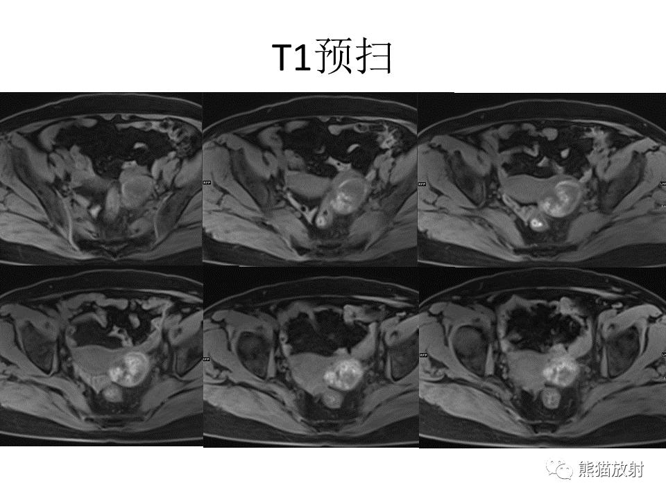 影像PPT - 【病例】卵巢卵泡膜纤维瘤2例MR影像-19