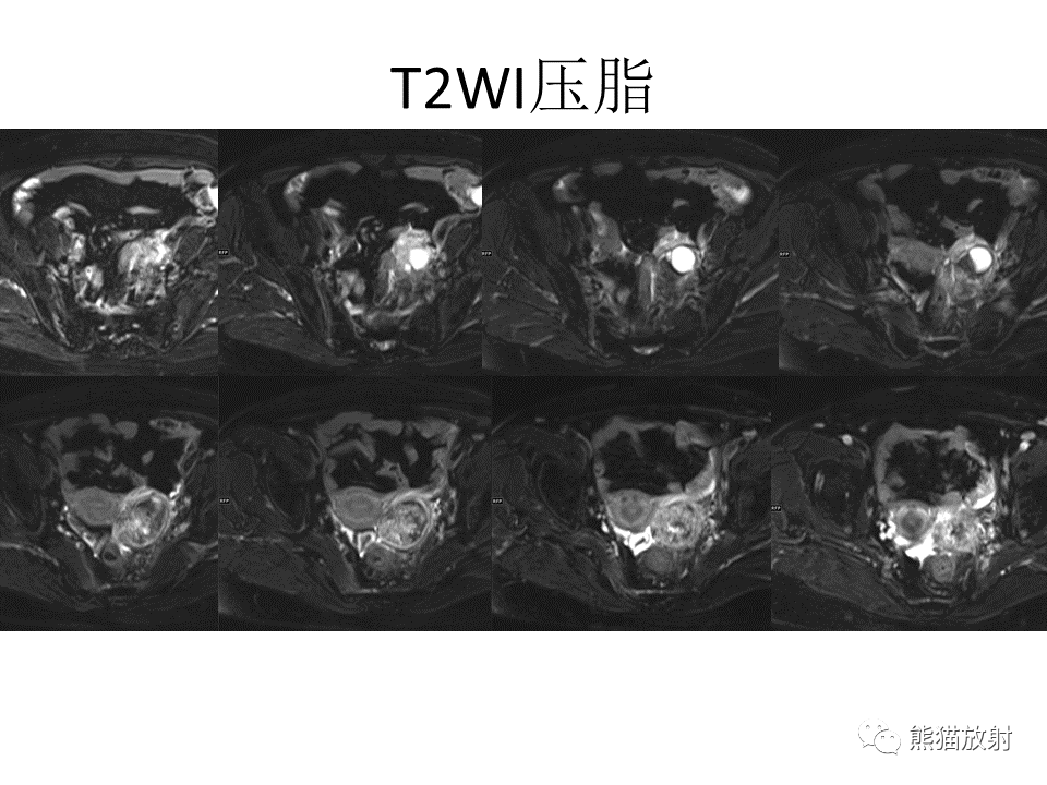 影像PPT - 【病例】卵巢卵泡膜纤维瘤2例MR影像-18