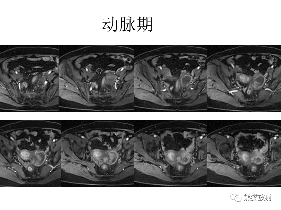 影像PPT - 【病例】卵巢卵泡膜纤维瘤2例MR影像-22