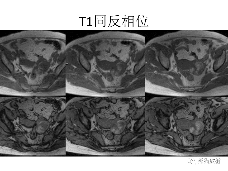 影像PPT - 【病例】卵巢卵泡膜纤维瘤2例MR影像-20