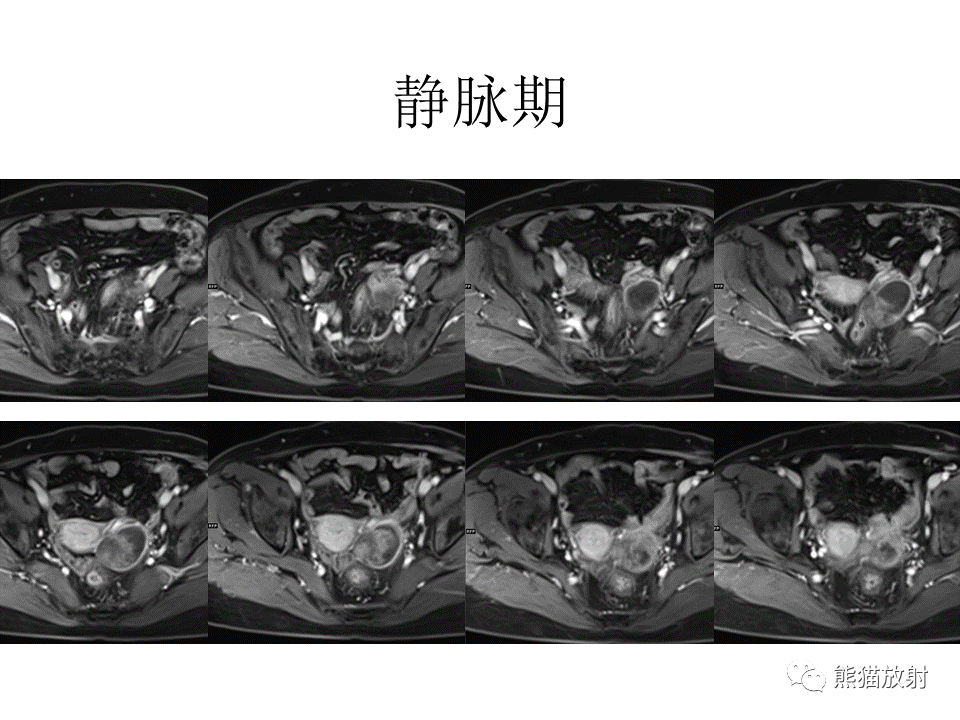 影像PPT - 【病例】卵巢卵泡膜纤维瘤2例MR影像-23