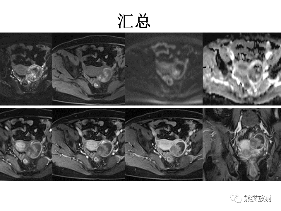 影像PPT - 【病例】卵巢卵泡膜纤维瘤2例MR影像-26
